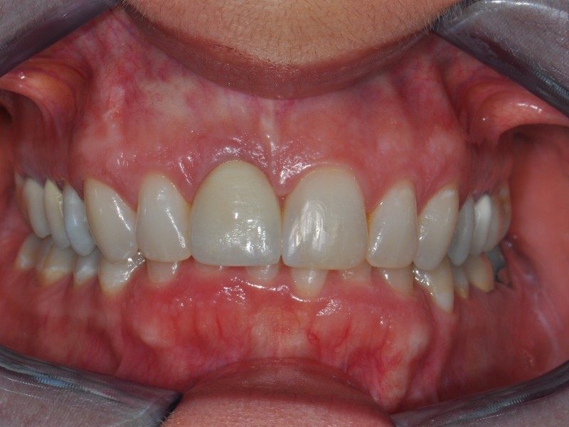 Esthetic Zone Implants PA Dental Implants