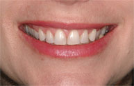 Gummy Smile Treatment Philadelphia