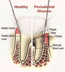 Graphic displaying periodontal disease