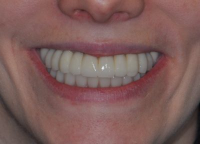 dental implants bucks county