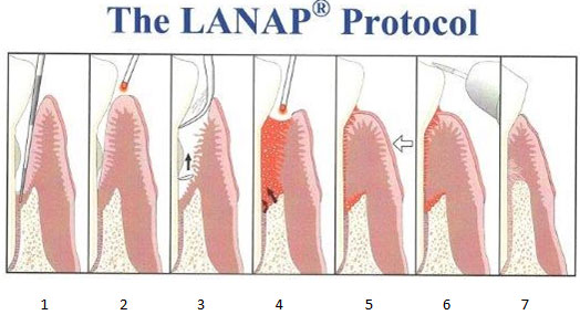 LANAP laser gum surgery Philadelphia, PA