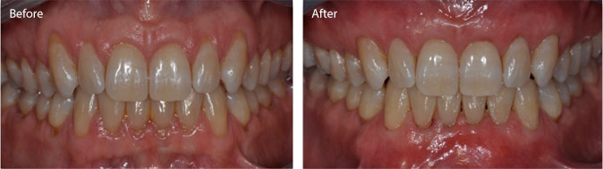 Gum Recession