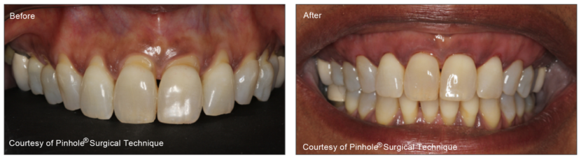 Pinhole Gum Recession Treatment Philadelphia