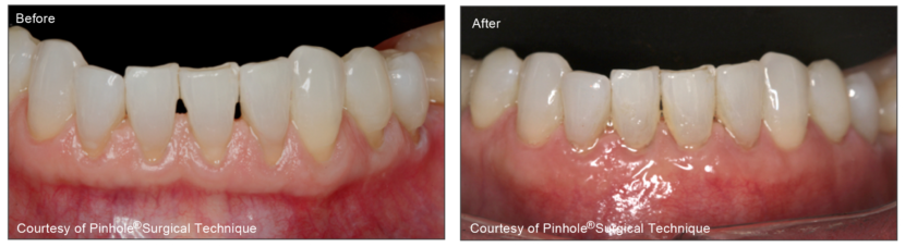 Treat Receding Gums Philadelphia