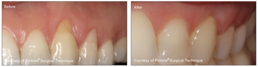 Noninvasive Gum Recession Treatment Philadelphia