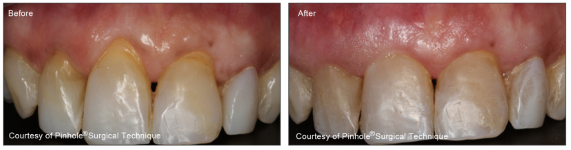 Pinhole Technique for Receding Gums Results