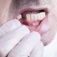 Missing Lower Tooth 